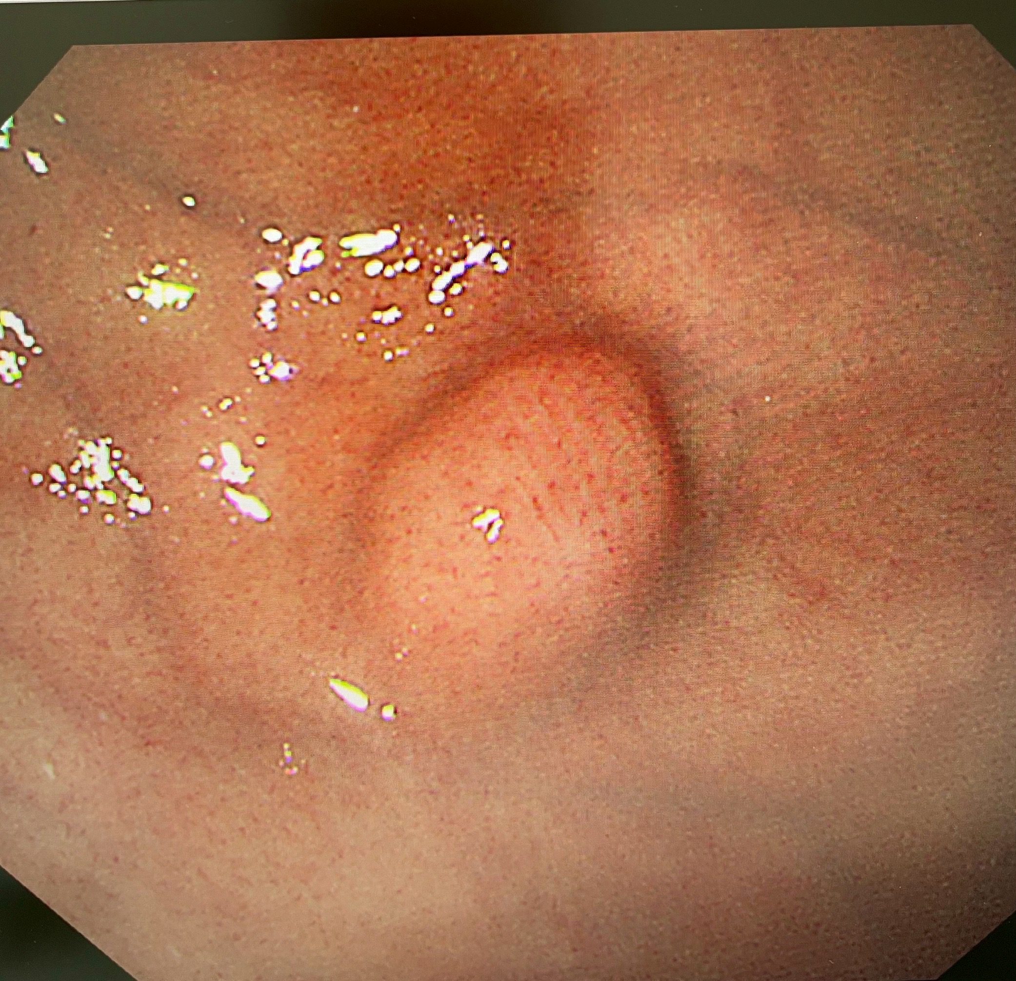 59歲女體內藏「未爆彈」 內視鏡手術25分鐘拆彈成功 13 IMG 0040